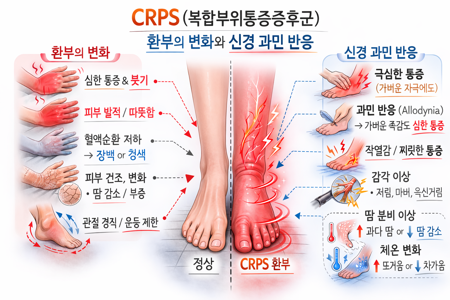 CRPS의 두 가지 유형